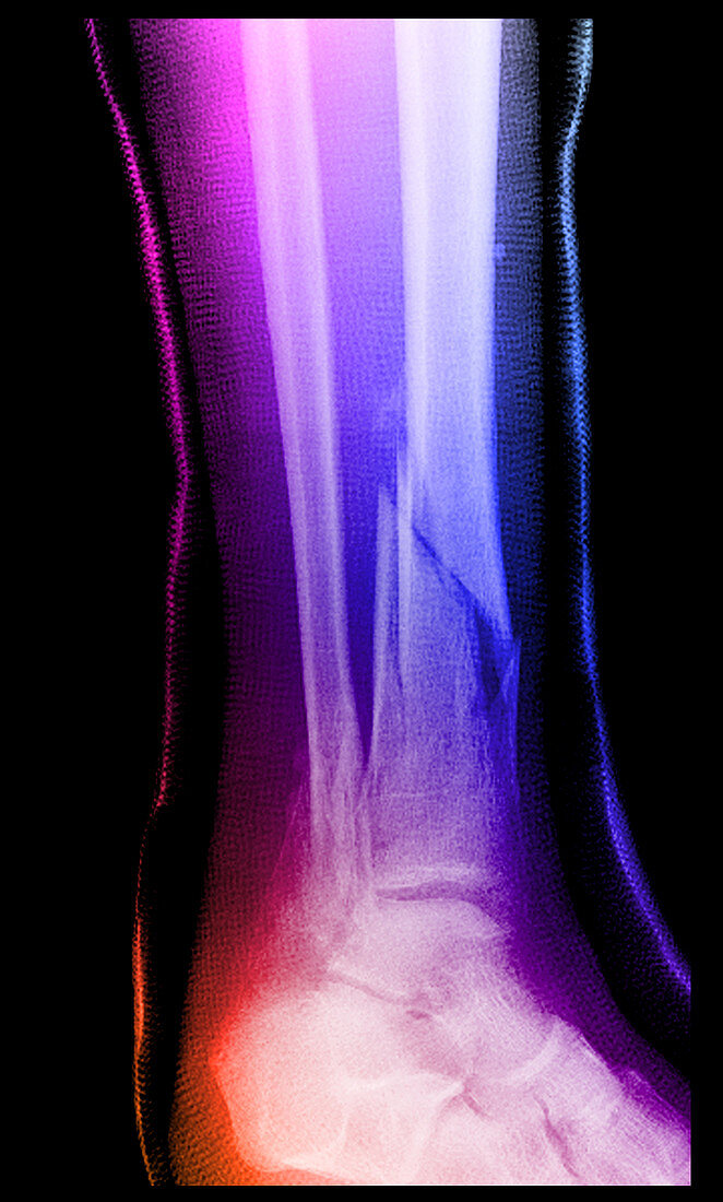 Leg Fractures with Cast