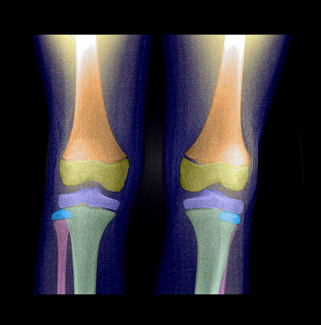 'Normal Pediatric Legs/Knees,X-Ray'