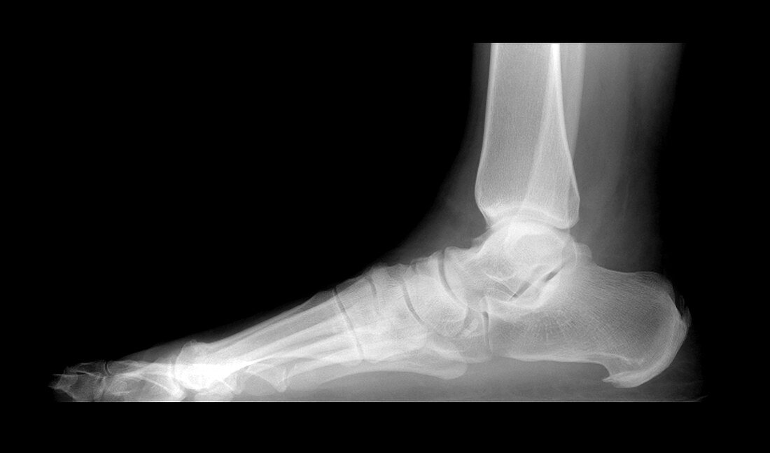 'Calcaneal Spurs,X-Ray'