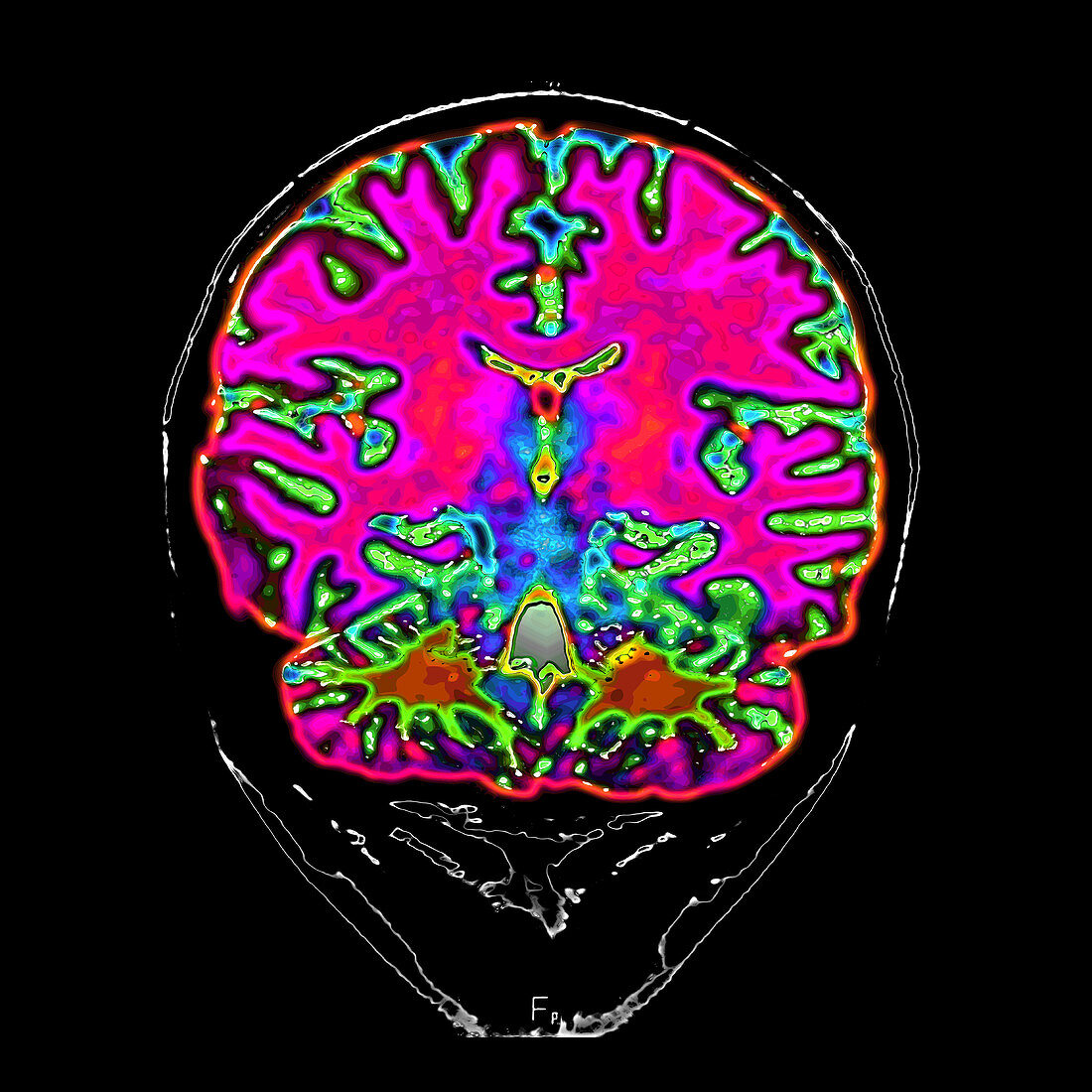 Normal MRI of Brain