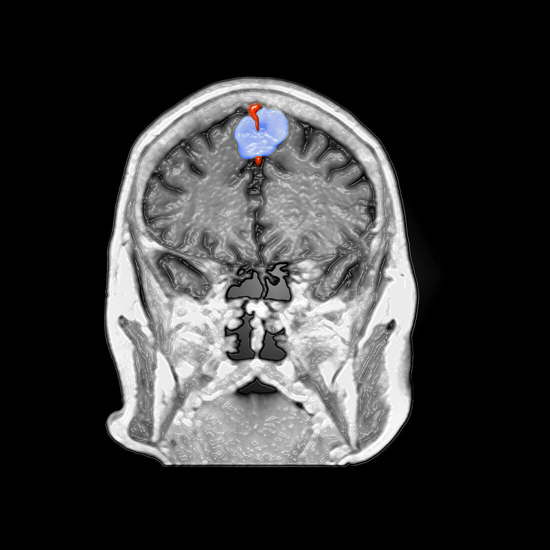 Color Enhanced MRI of Falx Meningioma