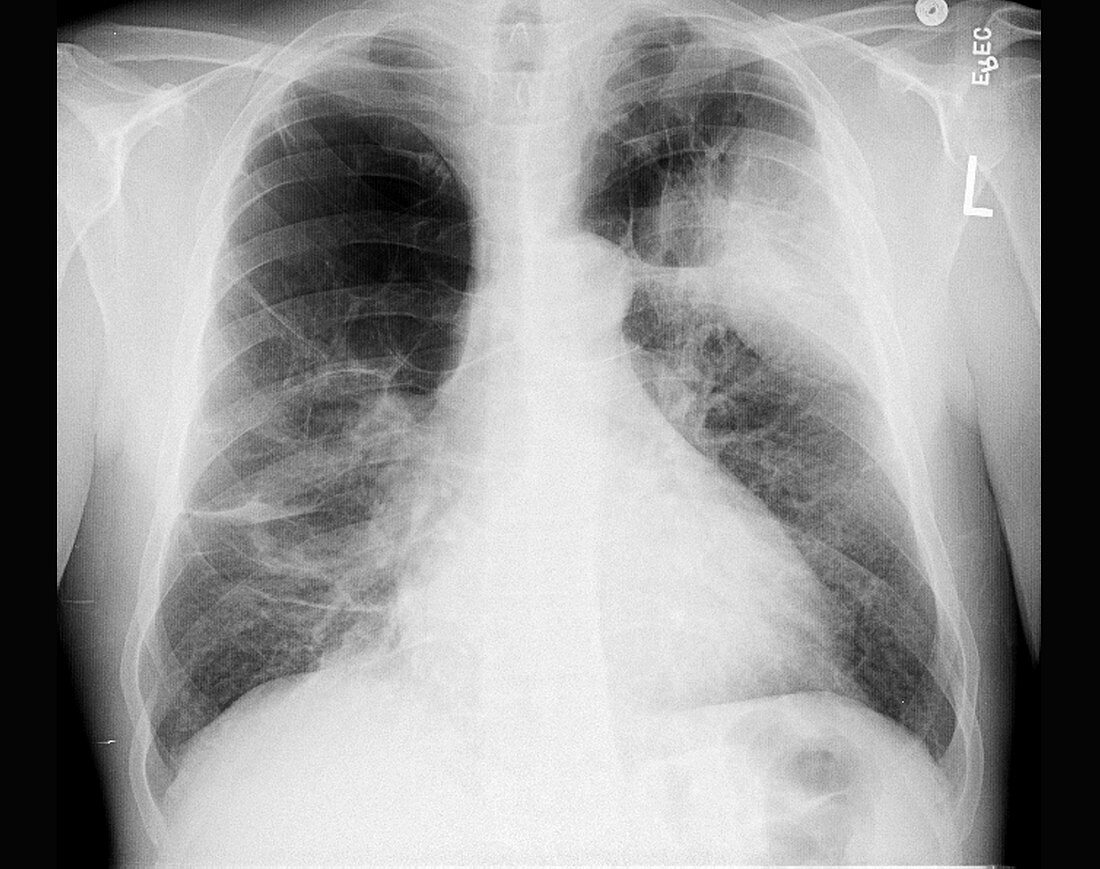 'Bullous Emphysema,X-Ray'