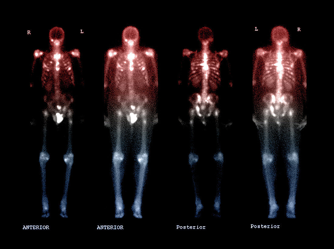 Bone Scan of Metastatic Disease