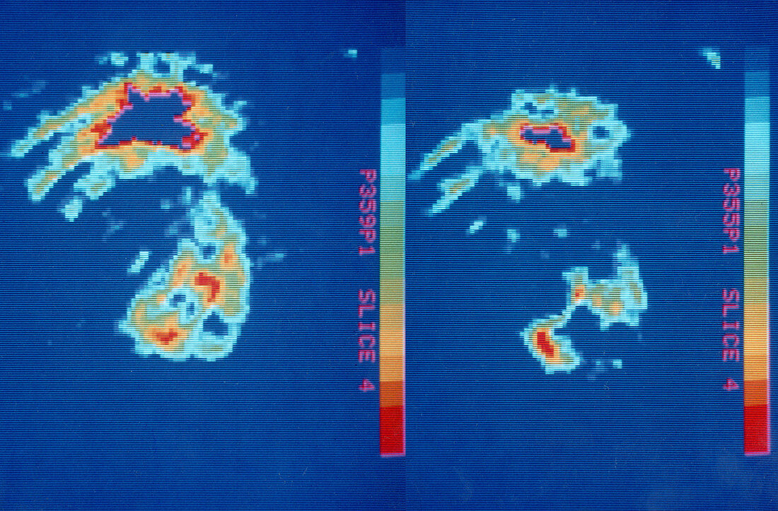 PET Scans of Human Heart With Blood Clot