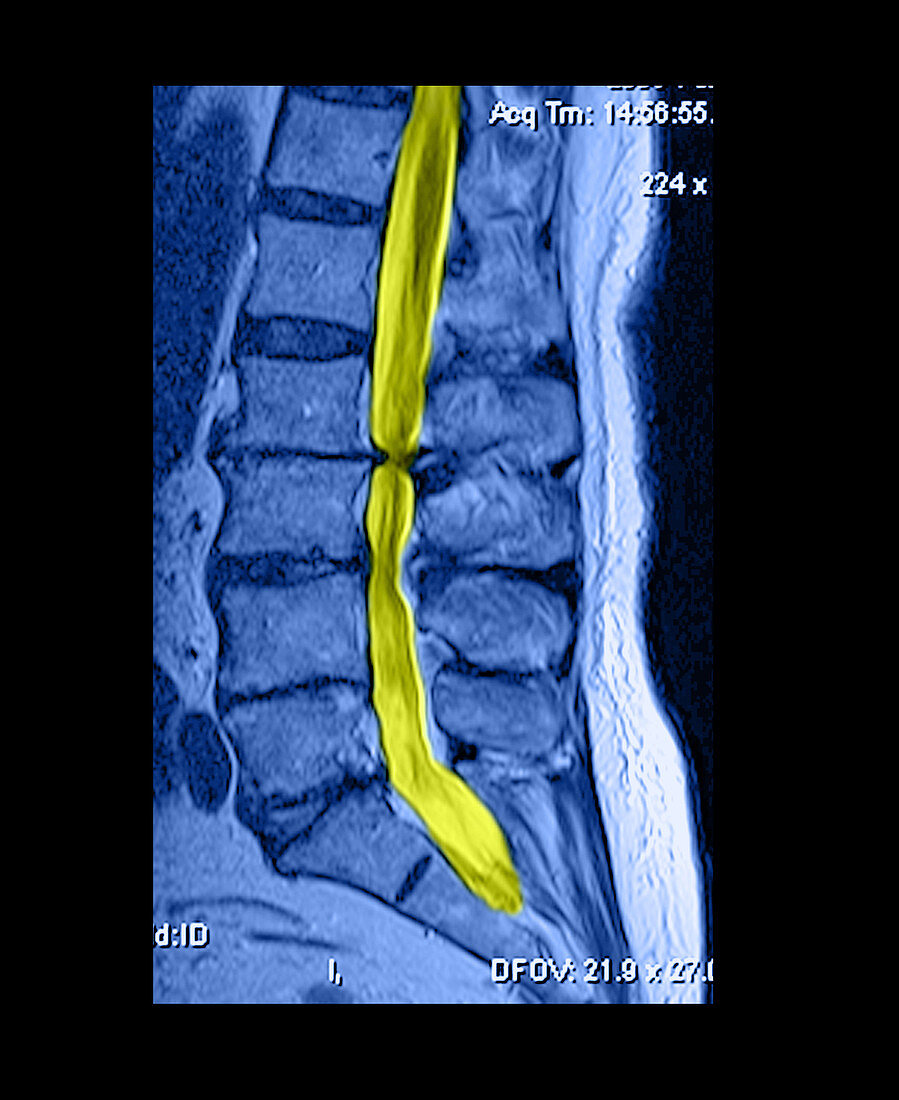 Severe Spinal Stenosis