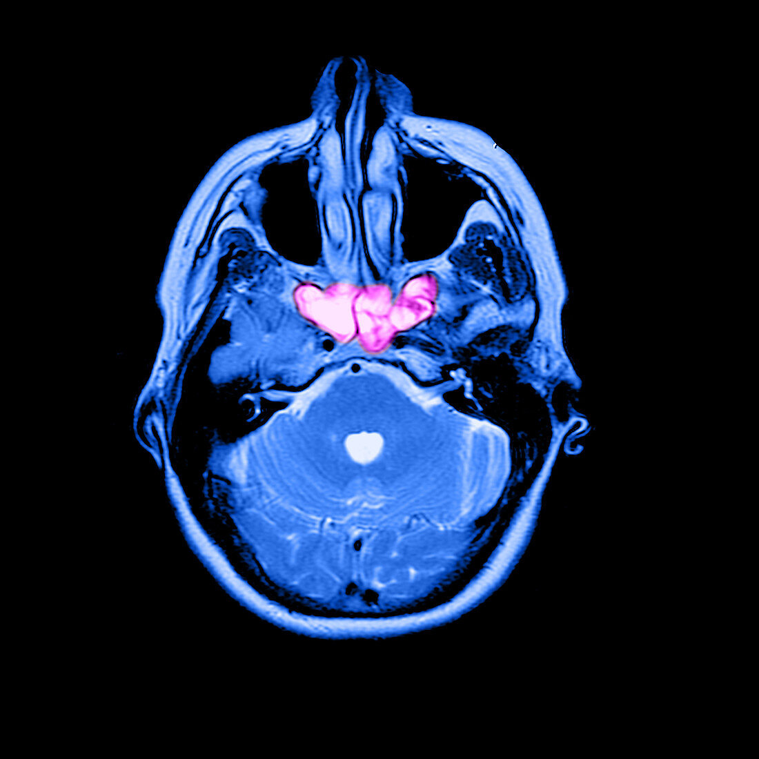 Sinusitis