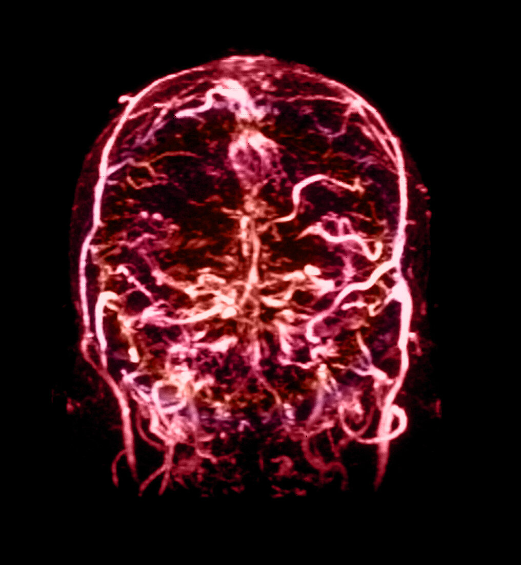MRI of Venogram of Dural Sinus Thrombosis