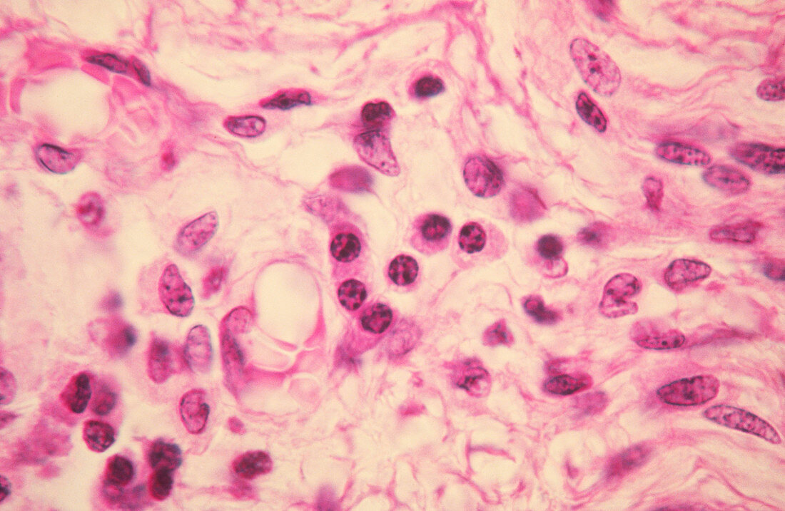 Infectious mononucleosis