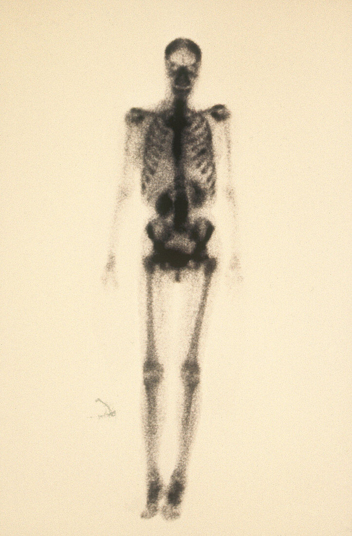 Normal Bone Scan