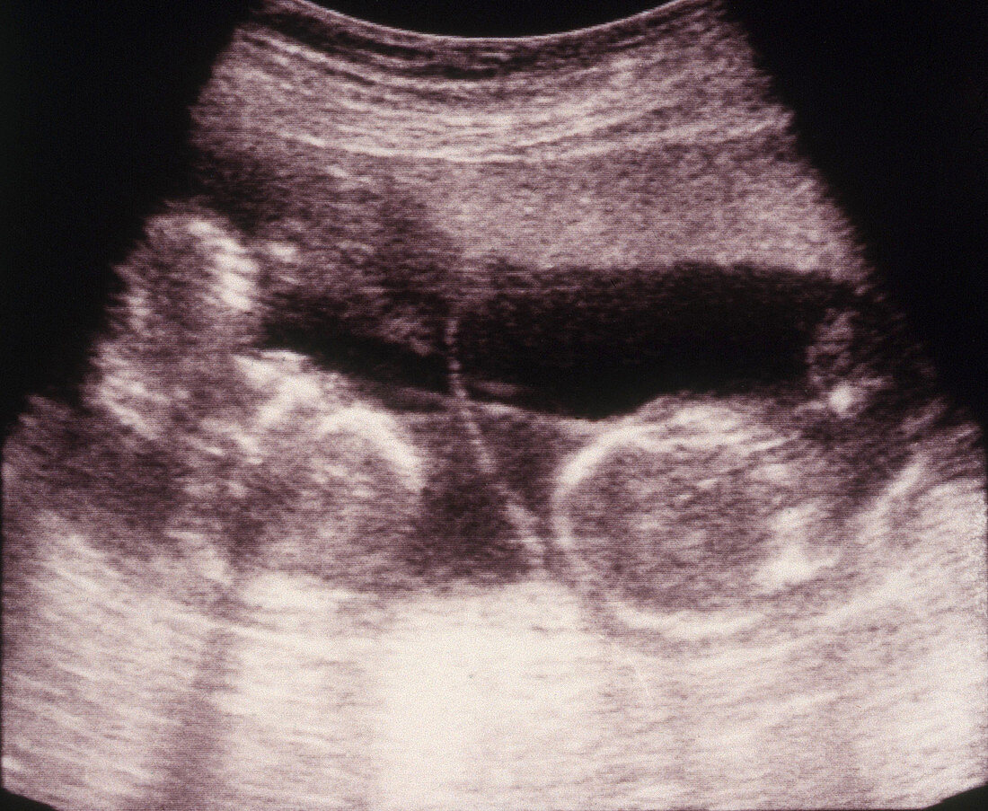 Ultrasound of Twins