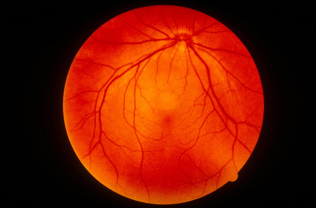 Retina