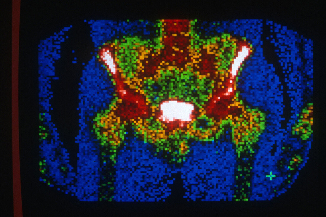 Normal Pelvis,Scintigram