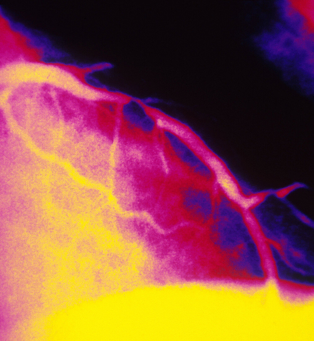 Narrowing in Coronary Artery (1 of 3)