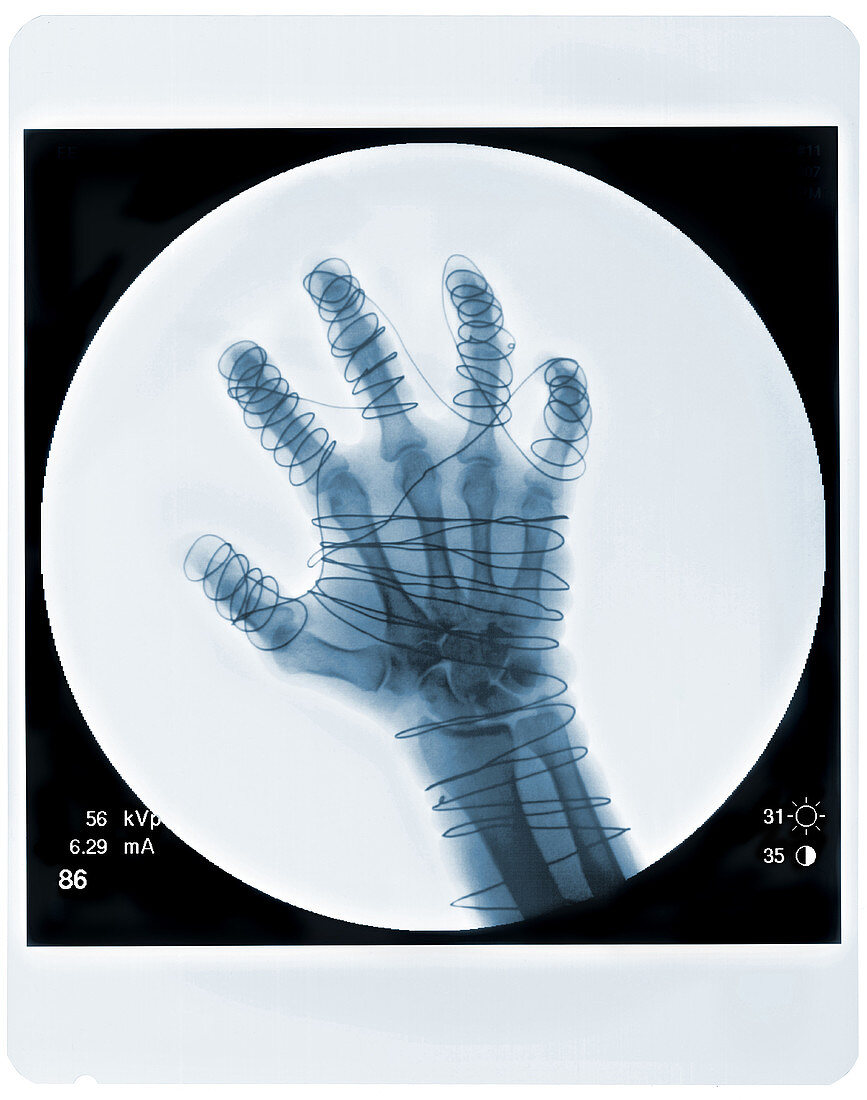 Hand,Fluoroscope