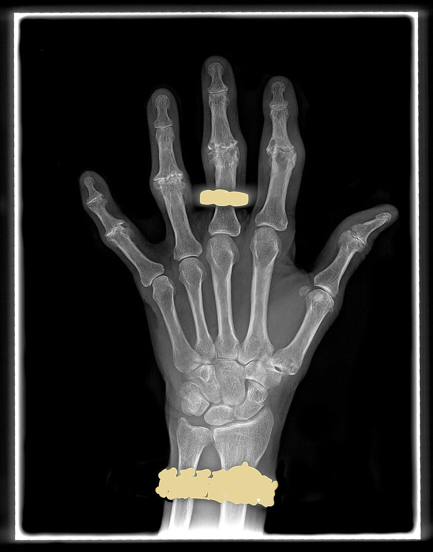 Osteoarthritis,Hand
