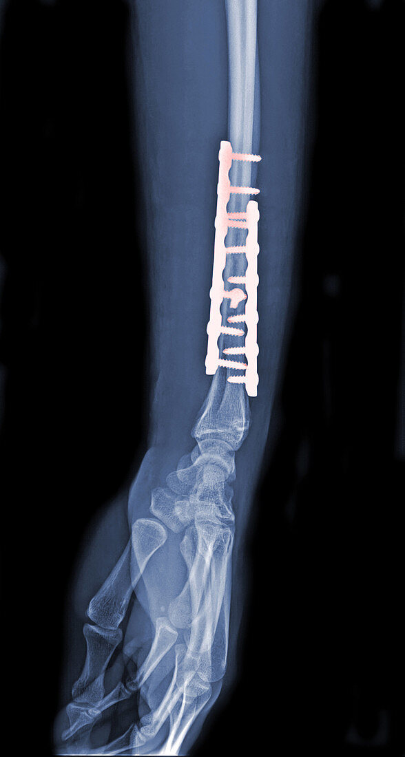 Forearm Fixation,X-Ray