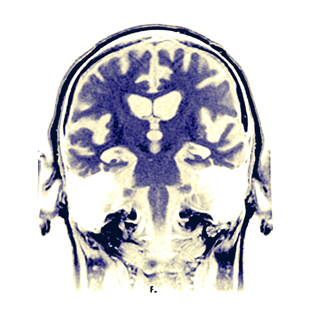 MRI of Alzheimers Disease,1 of 4