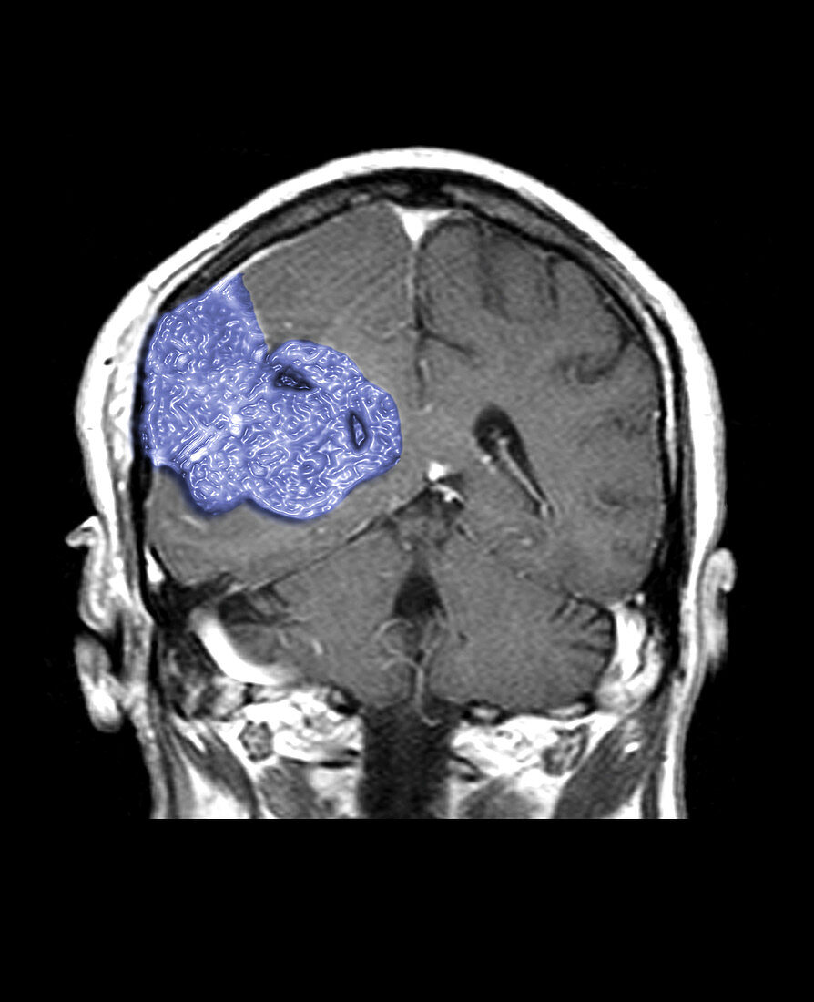 MRI of Malignant Brain Tumor