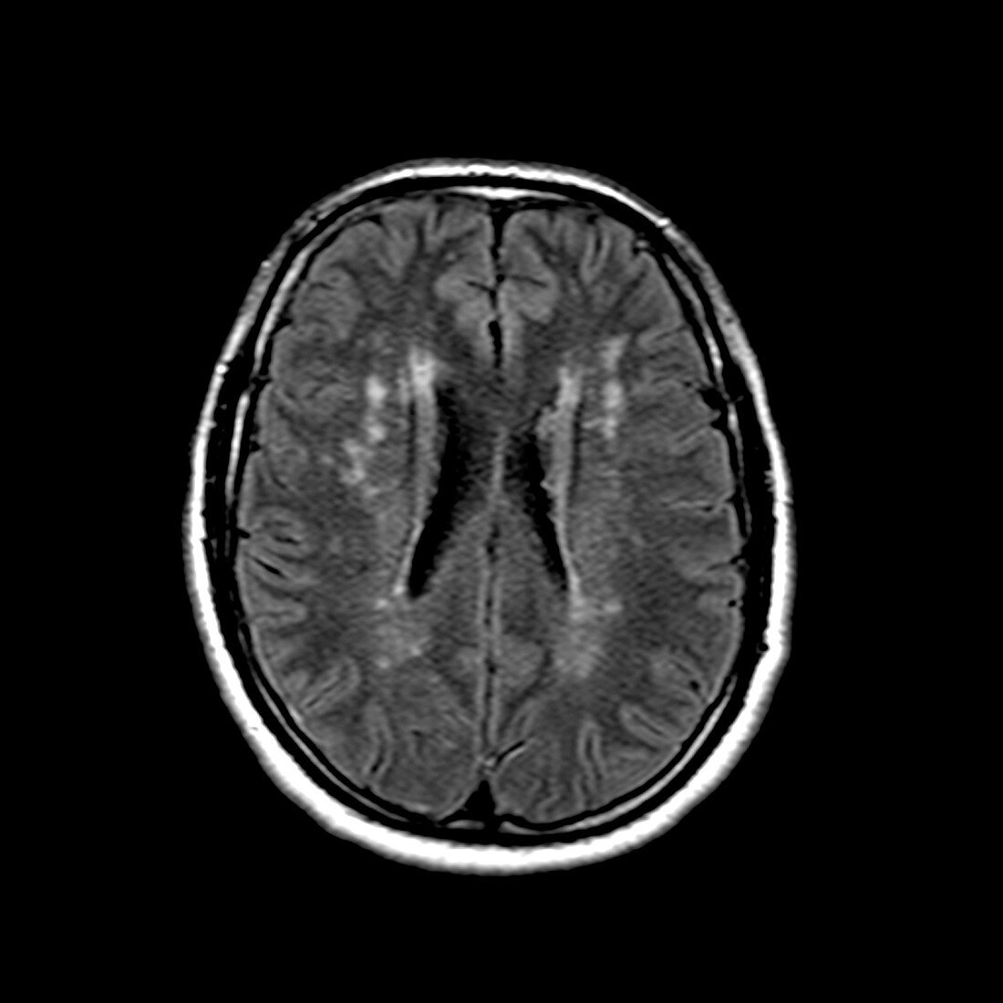 MRI of Cerebral Lyme Disease