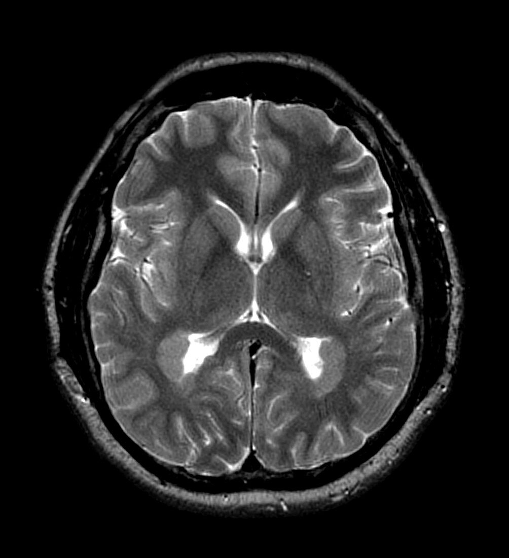 MRI of Heterotopic Gray Matter