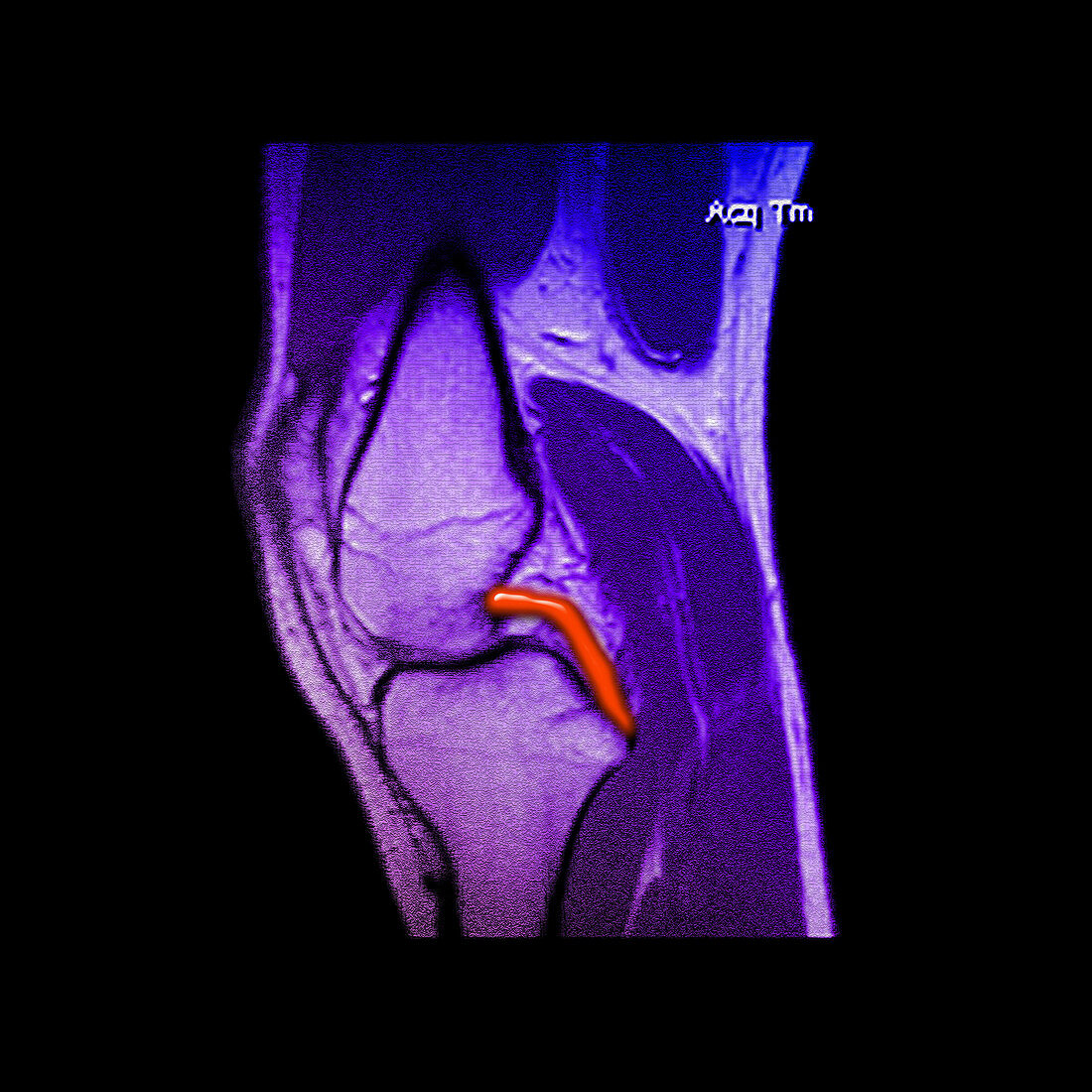 MRI of Knee Showing PCL