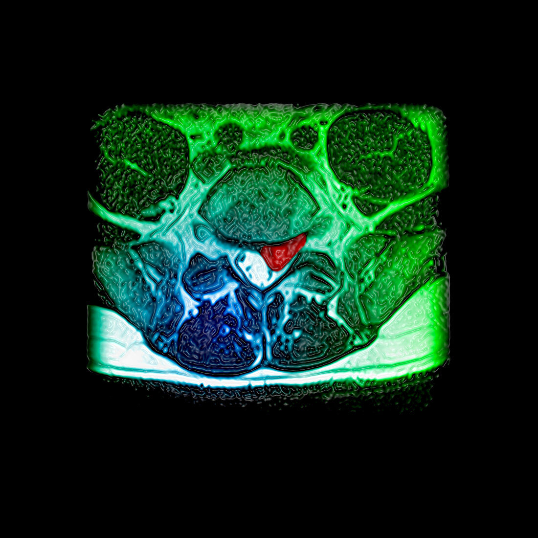 Lumbar Disc Herniation,MRI