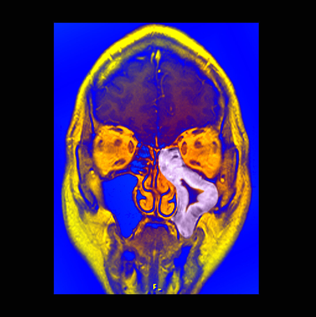 Maxillary Sinusitis,MRI
