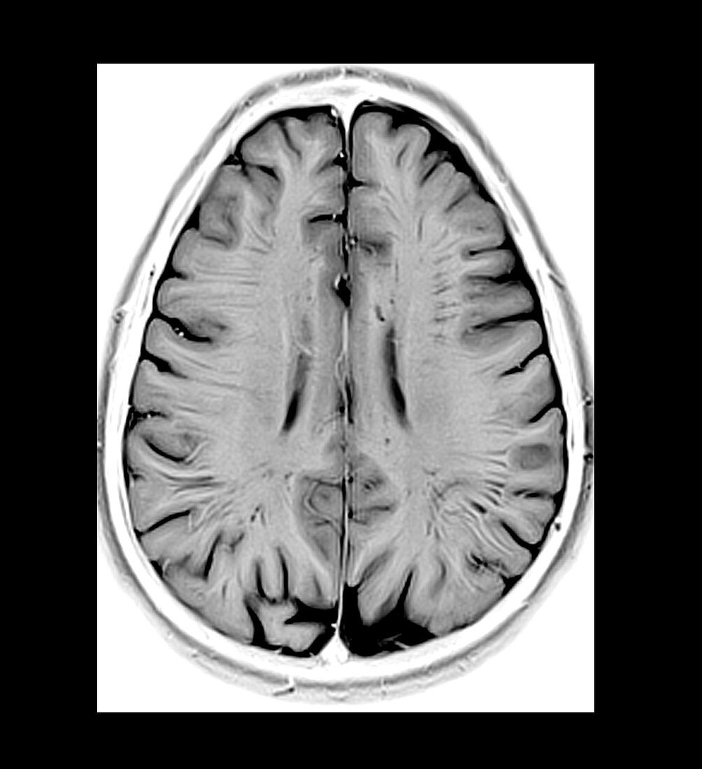 MRI of Dilated Perivascular Spaces