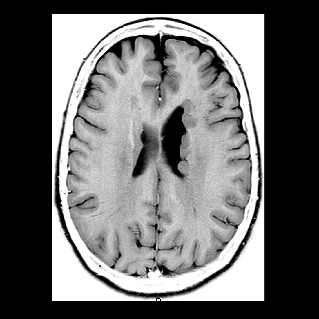 Heterotopic Gray Matter,MRI