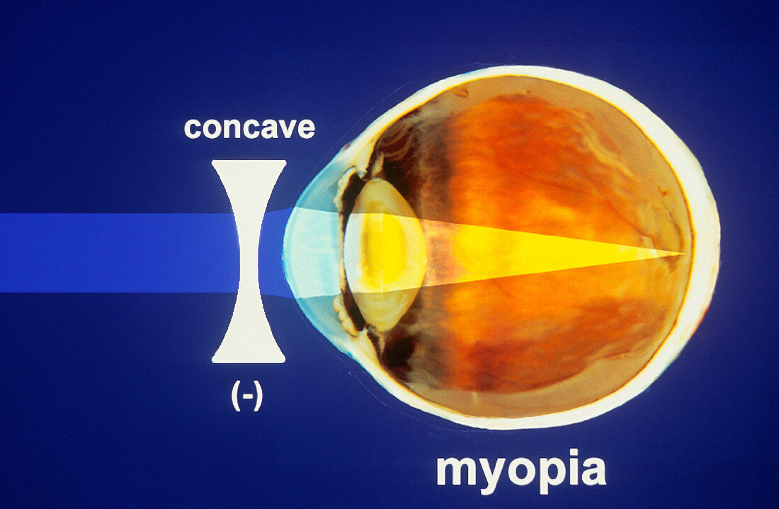 Correction of Myopia Diagram