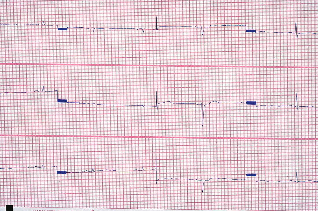 Sinus Bradycardia EKG