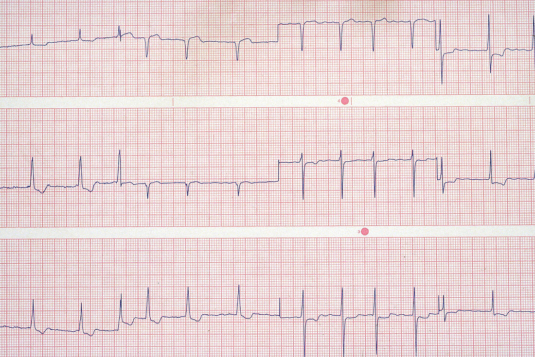 Atrial Fibrillation EKG