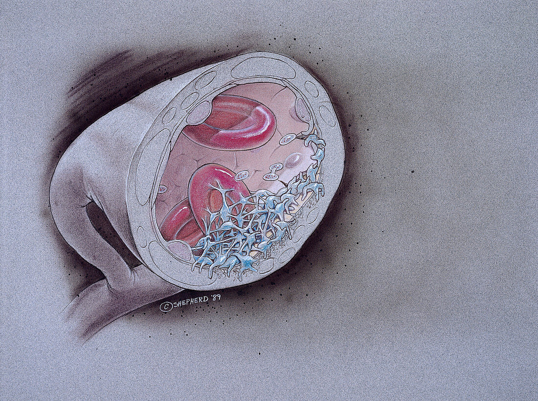 Intra-arterial clot formation