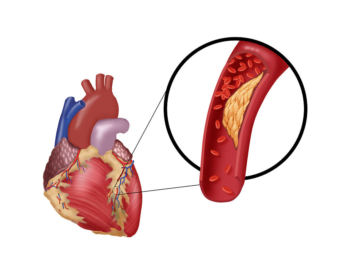 Atherosclerotic Coronary Artery Disease