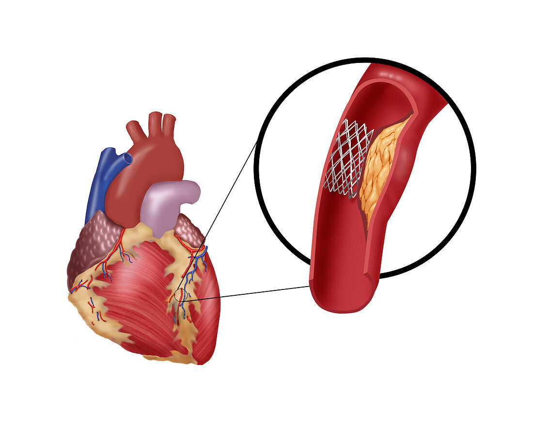 Angioplasty with Stenting,3 of 4