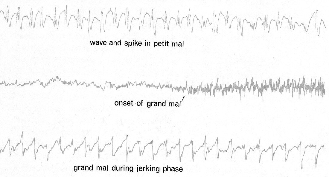 EEG of Epileptic Seizures