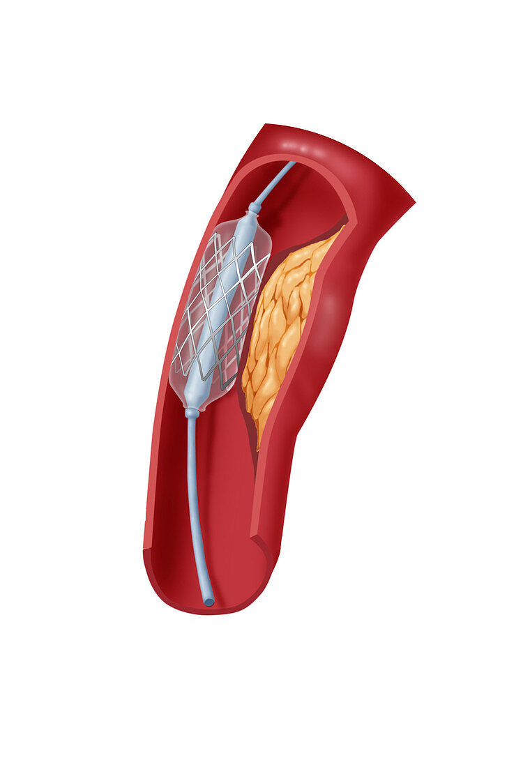 Angioplasty with Stenting,2 of 4