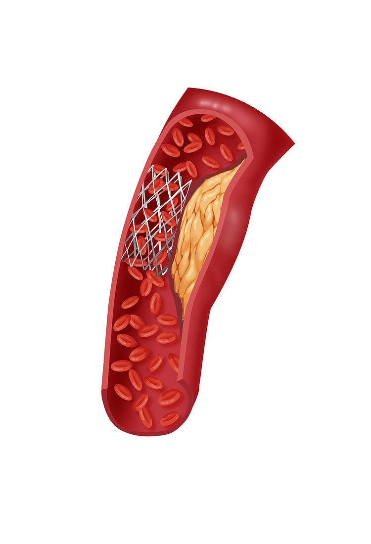 Angioplasty with Stenting,4 of 4