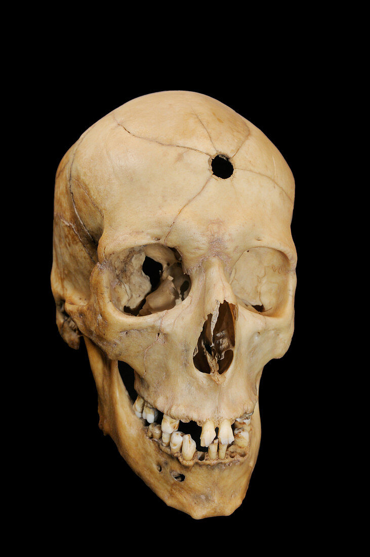 Bullet hole in skull