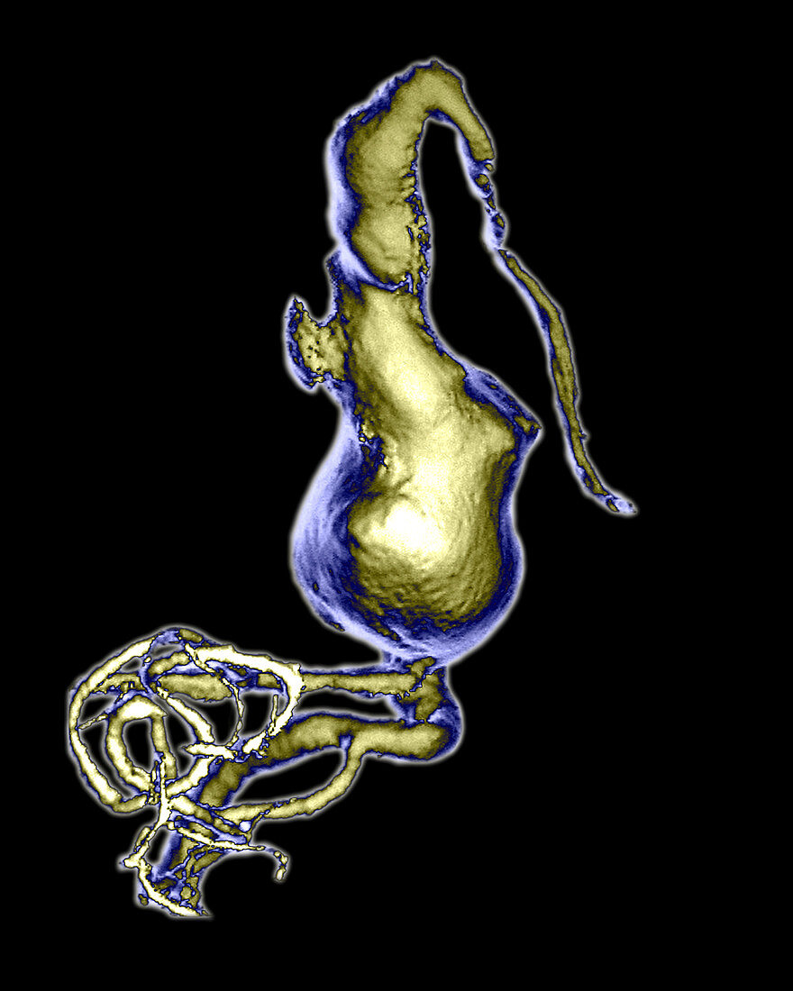 Basilar Artery Aneurysm,3D Scan