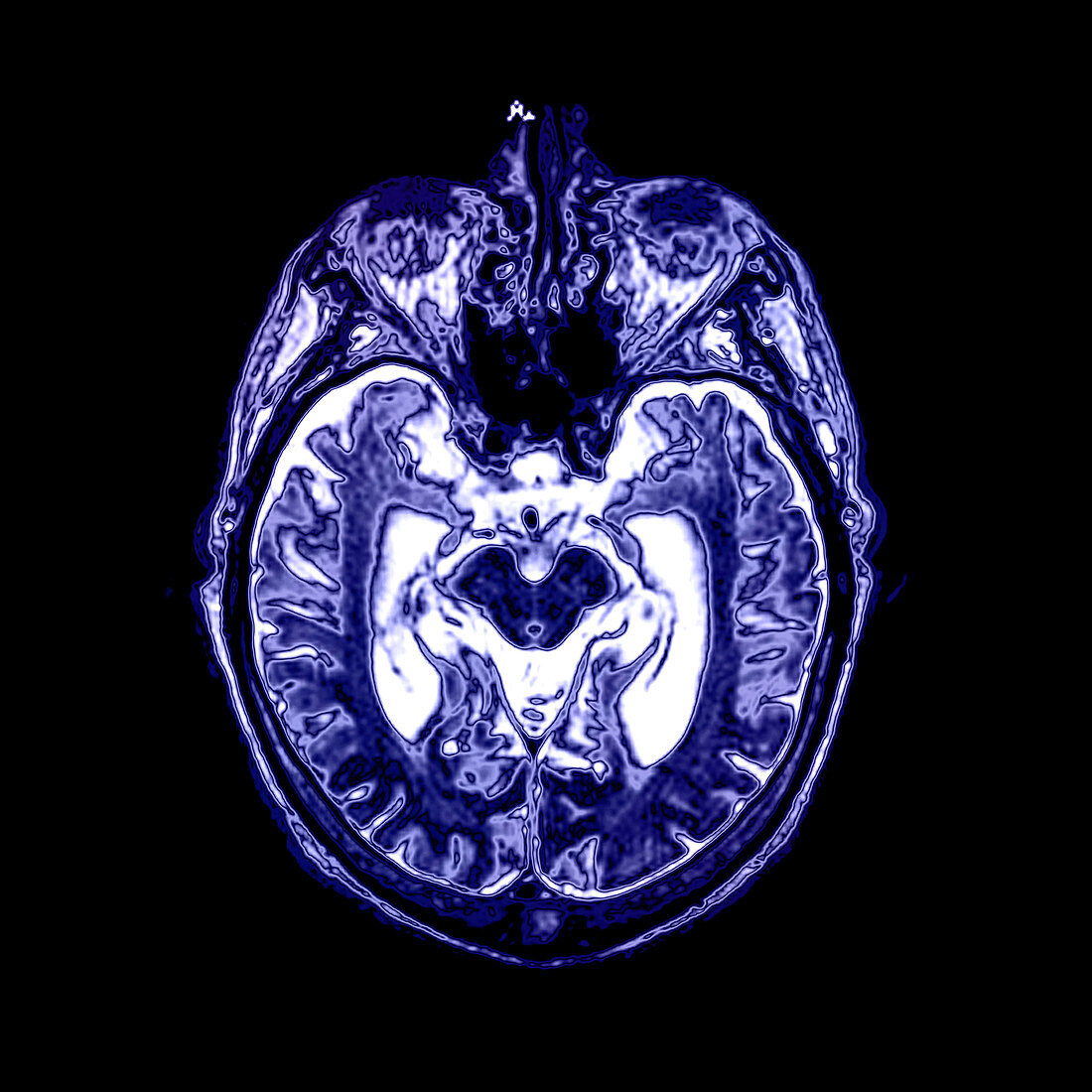 Alzheimer's Disease,MRI