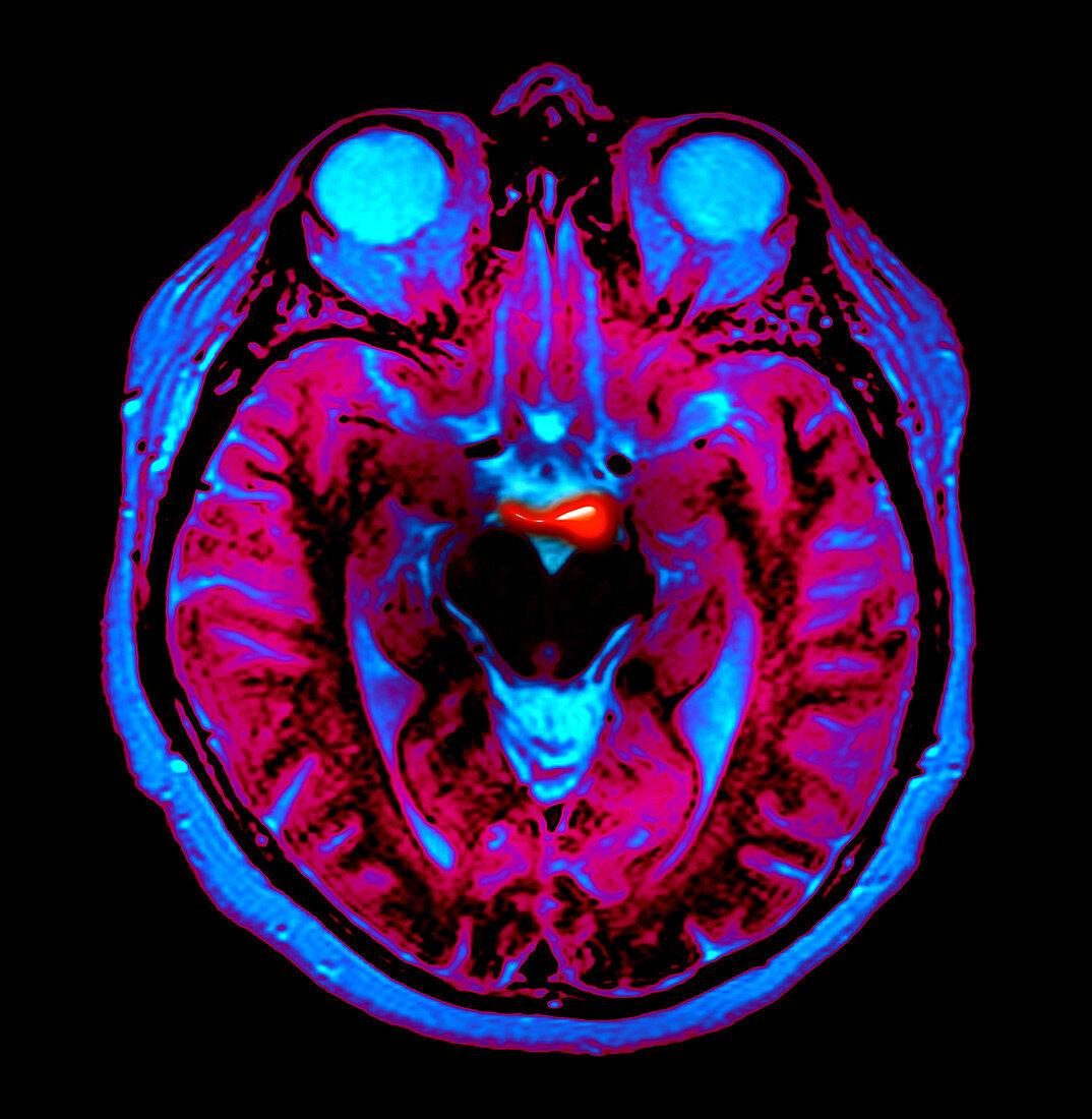 Basilar Artery Aneurysm,MRI