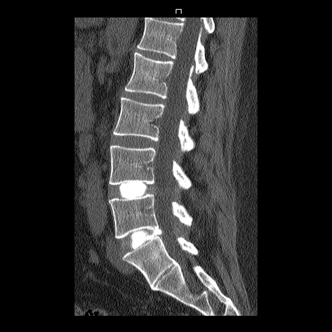 Spinal Disc Herniation,CT