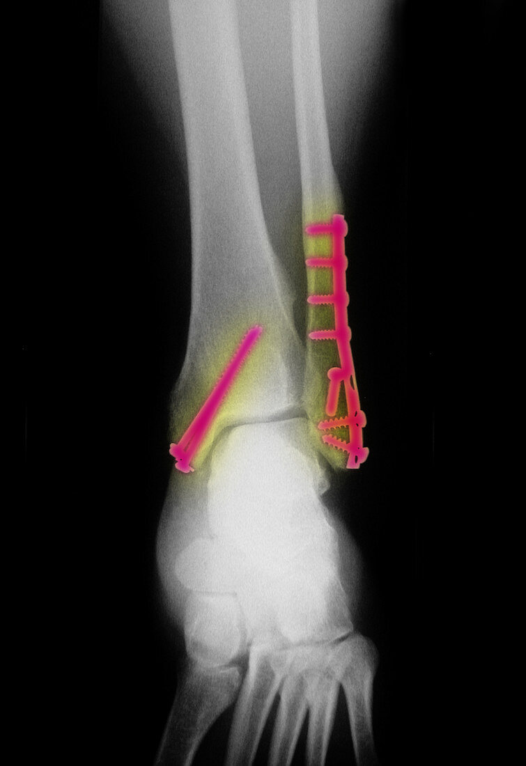 Fractured Ankle With Screws and Plates