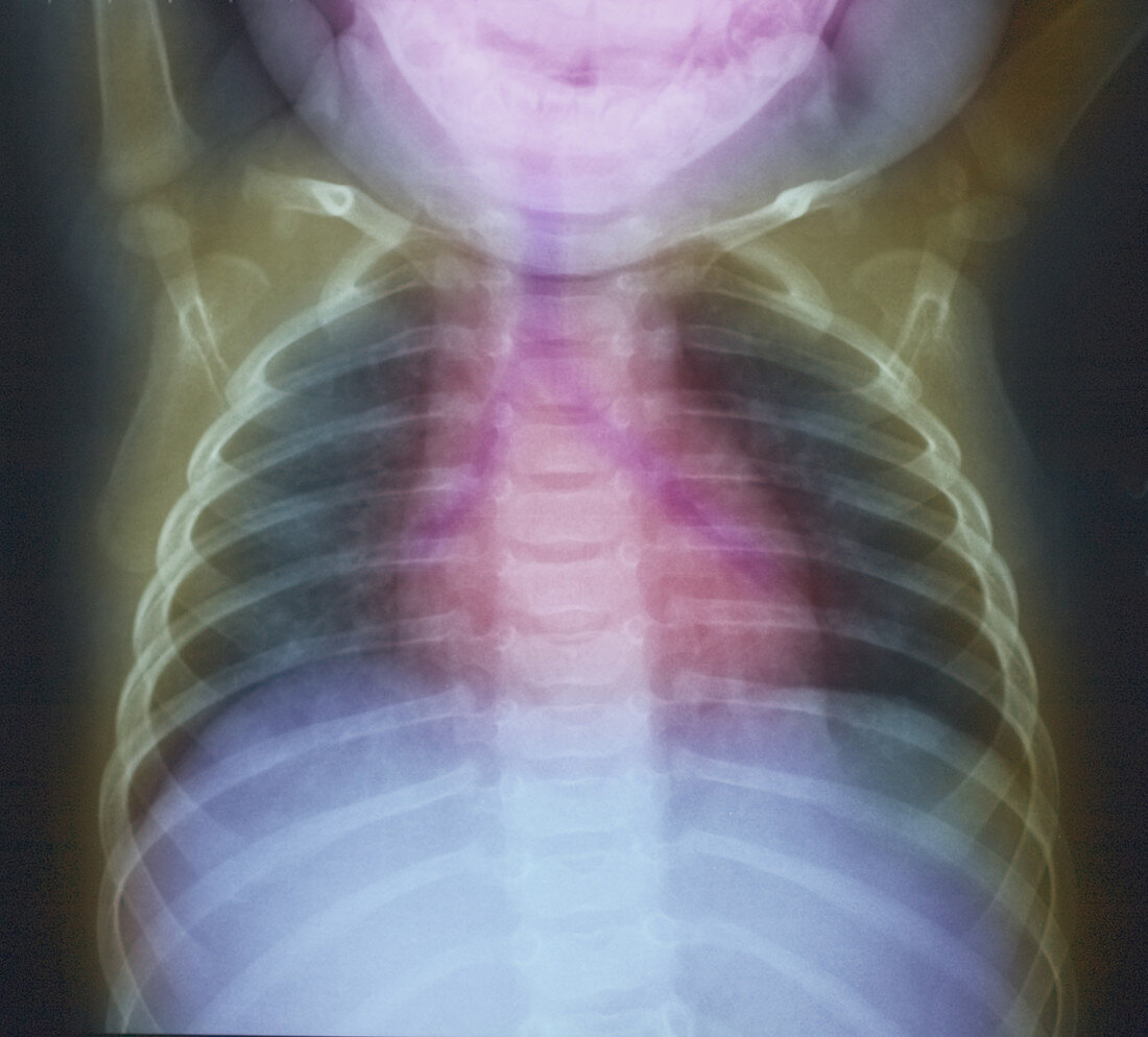 Chest X-ray of Healthy 7-Month-Old Boy