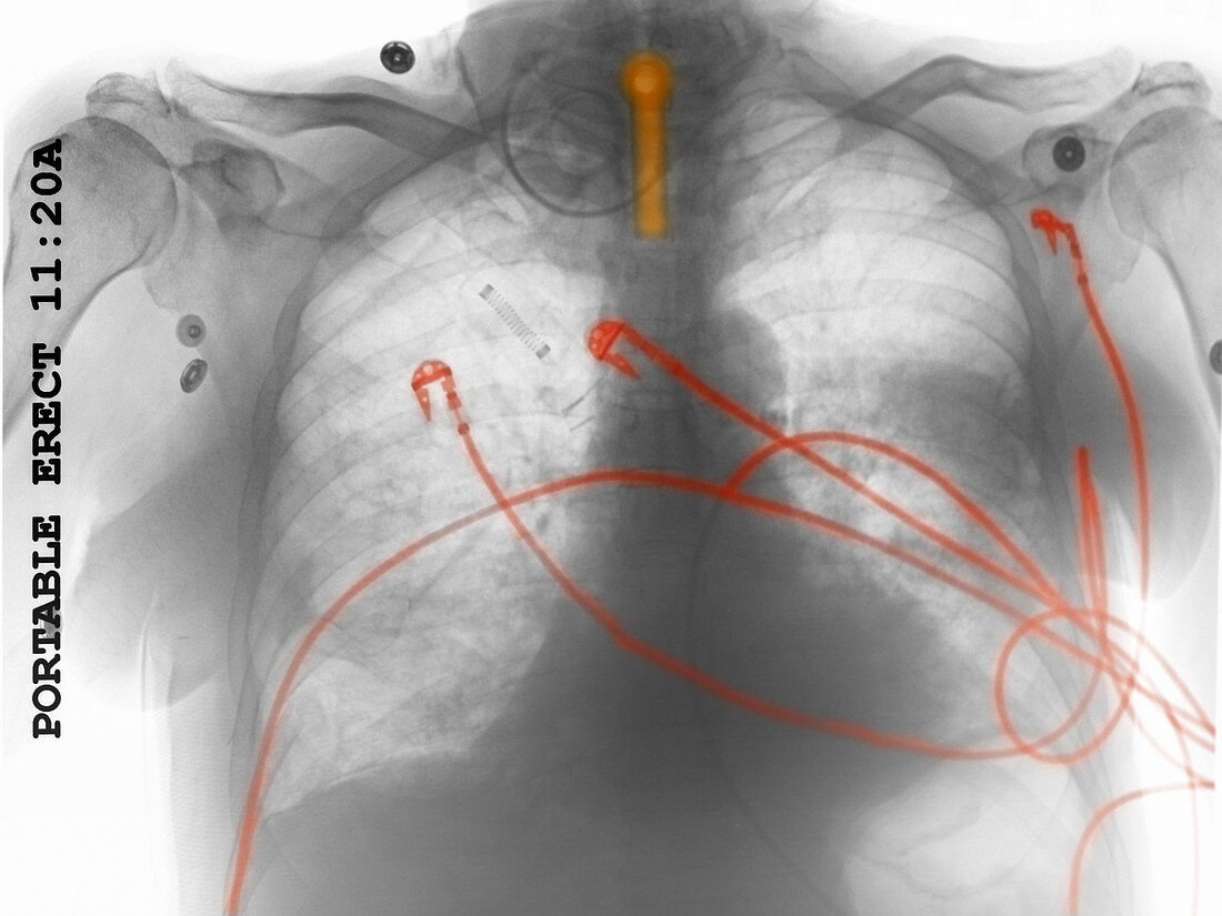 Chest X-ray of Intubated and Monitored Pa