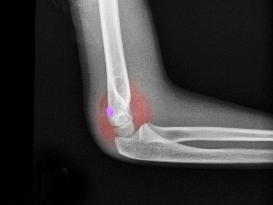 Distal Humerus Fracture in a 7 Year Old B