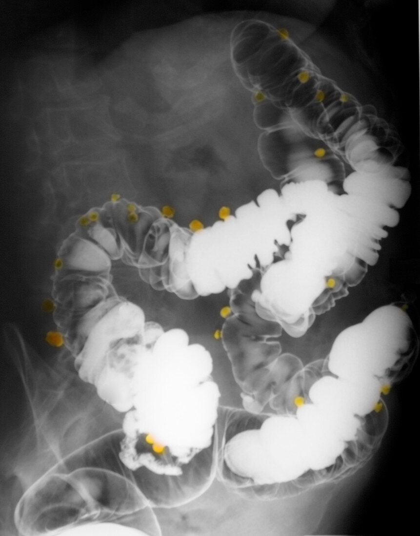 Diverticulosis of the Colon