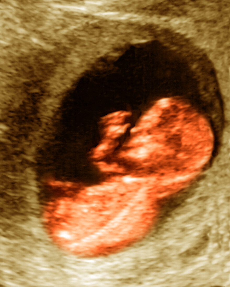 12 Week Old Fetus