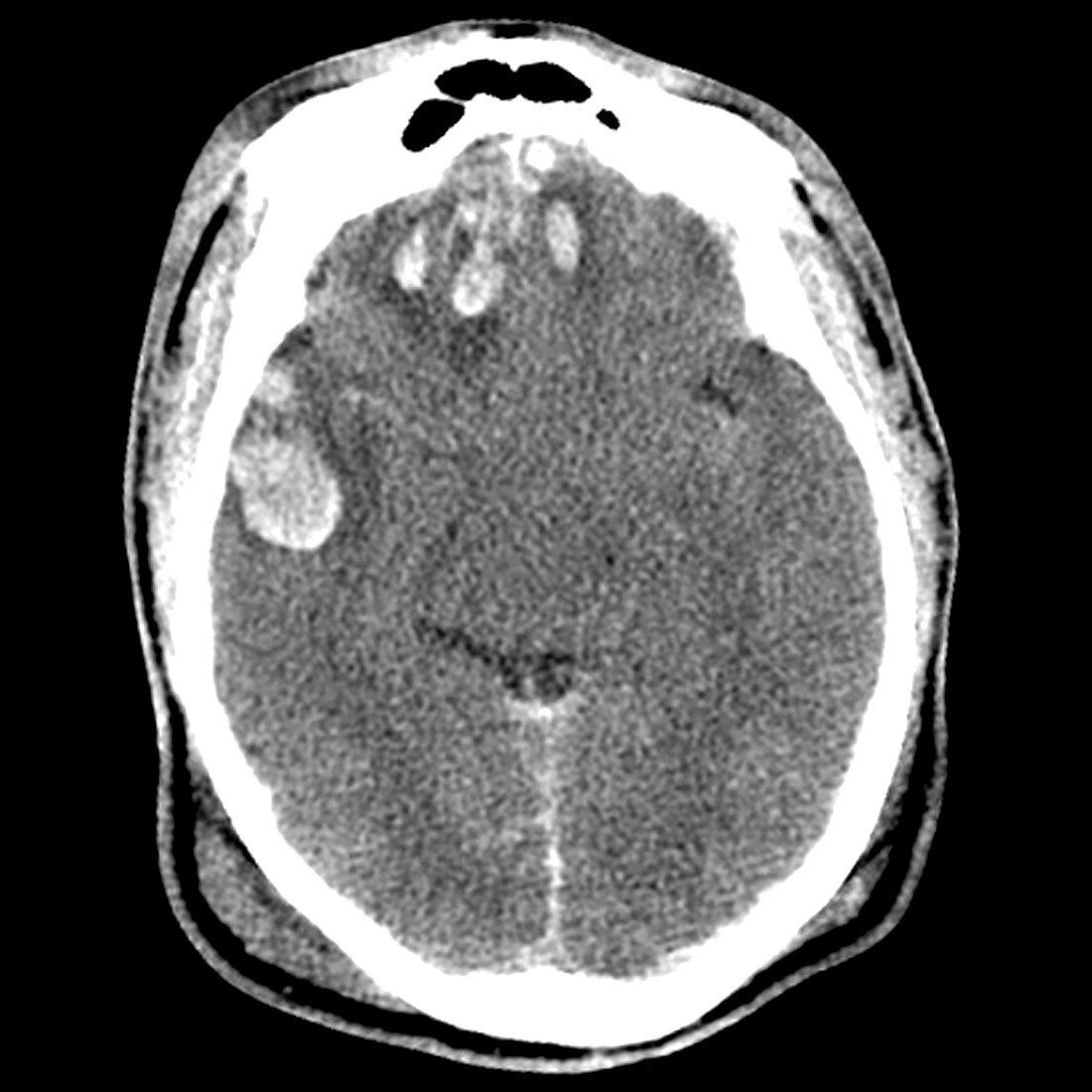 CT of Traumatic Brain Contusions